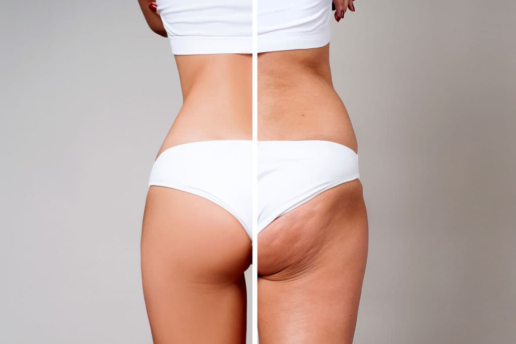 Tratamientos de reducción de grasa en Lugo